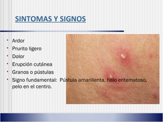 SINTOMAS Y SIGNOS
• Ardor
• Prurito ligero
• Dolor
• Erupción cutánea
• Granos o pústulas
• Signo fundamental: Pústula amarillenta, halo eritematoso,
pelo en el centro.
 