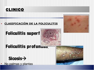 CLINICO
• CLASIFICACIÒN DE LA FOLICULITIS
Foliculitis superficial 
Foliculitis profundas
Sicosis
• No palmas y plantas
 