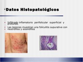 Datos Histopatológicos
• Infiltrado inflamatorio perifolicular superficial y
profundo.
• Las lesiones muestran una foliculitis supurativa con
• neutrófilos y eosinófilos
 