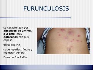 FURUNCULOSIS
se caracterizan por
abscesos de 3mms.
a 2 cms. muy
dolorosos con pus
espeso .
•deja cicatriz
• adenopatías, fiebre y
malestar general.
Dura de 5 a 7 días
 