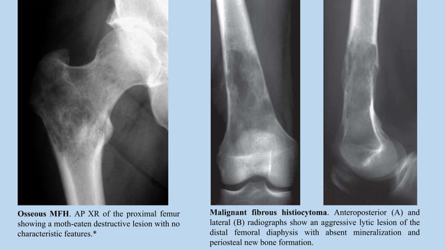 Malignant bone tumours | PPTX | Bone and Joint Conditions | Diseases ...