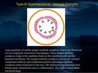 Type-III Hypersensitivity: Immune Complex
Large quantities of soluble antigen-antibody complexes form in the blood and
are not completely removed by macrophages. These antigen-antibody
complexes lodge in the capillaries between the endothelial cells and the
basement membrane. The antigen-antibody complexes activate the classical
complement pathway and complement proteins and antigen-antibody
complexes attract leukocytes to the area. The leukocytes then discharge their
killing agents and promote massive inflammation. This leads to tissue death
and hemorrhage
 