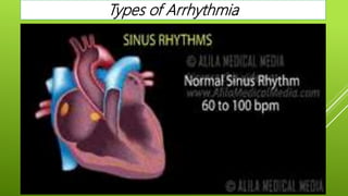 Types of Arrhythmia
 
