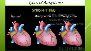 Types of Arrhythmia
 