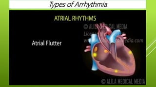 Types of Arrhythmia
 