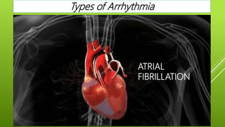 Types of Arrhythmia
ATRIAL
FIBRILLATION
 