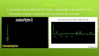 AV blocks
A conduction block within the AV node , occasionally in the bundle of His,
that impairs impulse conduction from the atria to the ventricles.
 