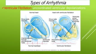 Ventricular Fibrillation: uncoordinated ventricular depolarizations
Types of Arrhythmia
 