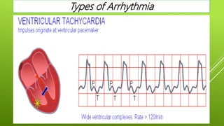 Types of Arrhythmia
 