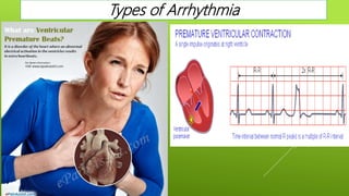 Types of Arrhythmia
 