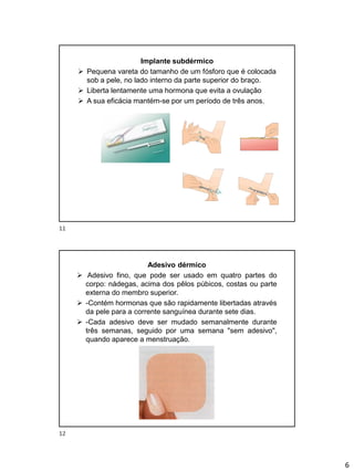 6
Implante subdérmico
➢ Pequena vareta do tamanho de um fósforo que é colocada
sob a pele, no lado interno da parte superior do braço.
➢ Liberta lentamente uma hormona que evita a ovulação
➢ A sua eficácia mantém-se por um período de três anos.
Adesivo dérmico
➢ Adesivo fino, que pode ser usado em quatro partes do
corpo: nádegas, acima dos pêlos púbicos, costas ou parte
externa do membro superior.
➢ -Contém hormonas que são rapidamente libertadas através
da pele para a corrente sanguínea durante sete dias.
➢ -Cada adesivo deve ser mudado semanalmente durante
três semanas, seguido por uma semana "sem adesivo",
quando aparece a menstruação.
11
12
 