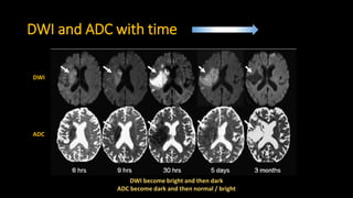 3. mri in acute stroke 2017 vietnam v2 | PPTX