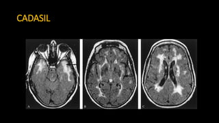 3. mri in acute stroke 2017 vietnam v2 | PPTX