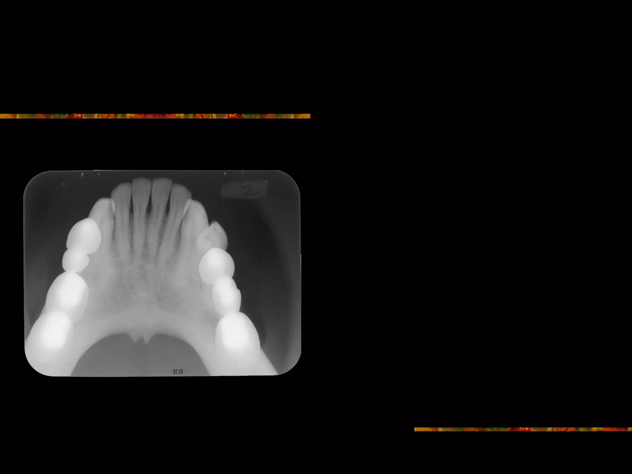 Intra Oral radiographic anatomical landmarks | PPT