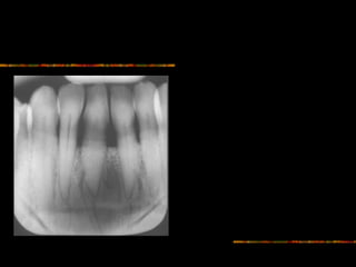 Drot Radiography Intra Oral radiographic anatomical landmarks | PPT