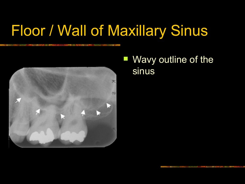 Intra Oral radiographic anatomical landmarks