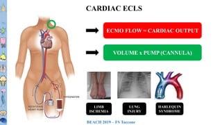BEACH 2019 – FS Taccone
T1T2T3T4T5T6
T7T8
T9
T10
T11T12L1L2L3
CARDIAC ECLS
ECMO FLOW = CARDIAC OUTPUT
VOLUME x PUMP (CANNULA)
LIMB
ISCHEMIA
LUNG
INJURY
HARLEQUIN
SYNDROME
 