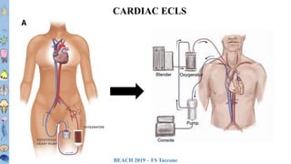 BEACH 2019 – FS Taccone
T1T2T3T4T5T6
T7T8
T9
T10
T11T12L1L2L3
CARDIAC ECLS
 