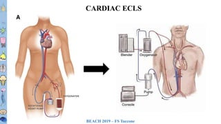 BEACH 2019 – FS Taccone
T1T2T3T4T5T6
T7T8
T9
T10
T11T12L1L2L3
CARDIAC ECLS
 