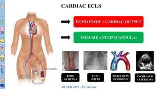 BEACH 2019 – FS Taccone
T1T2T3T4T5T6
T7T8
T9
T10
T11T12L1L2L3
CARDIAC ECLS
ECMO FLOW = CARDIAC OUTPUT
VOLUME x PUMP (CANNULA)
LIMB
ISCHEMIA
LUNG
INJURY
HARLEQUIN
SYNDROME
INCREASED
AFTERLOAD
 