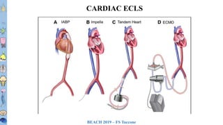 BEACH 2019 – FS Taccone
T1T2T3T4T5T6
T7T8
T9
T10
T11T12L1L2L3
CARDIAC ECLS
 