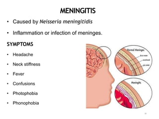MENINGITIS
• Caused by Neisseria meningitidis
• Inflammation or infection of meninges.
SYMPTOMS
• Headache
• Neck stiffness
• Fever
• Confusions
• Photophobia
• Phonophobia
28
 