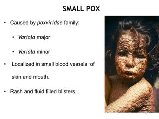 SMALL POX
• Caused by poxviridae family:
• Variola major
• Variola minor
• Localized in small blood vessels of
skin and mouth.
• Rash and fluid filled blisters.
30
 