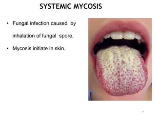 SYSTEMIC MYCOSIS
• Fungal infection caused by
inhalation of fungal spore,
• Mycosis initiate in skin.
34
 