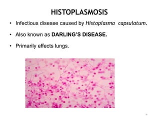HISTOPLASMOSIS
• Infectious disease caused by Histoplasma capsulatum.
• Also known as DARLING’S DISEASE.
• Primarily effects lungs.
36
 