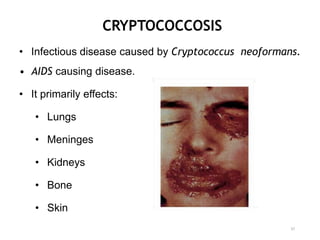 CRYPTOCOCCOSIS
• Infectious disease caused by Cryptococcus neoformans.
• AIDS causing disease.
• It primarily effects:
• Lungs
• Meninges
• Kidneys
• Bone
• Skin
37
 