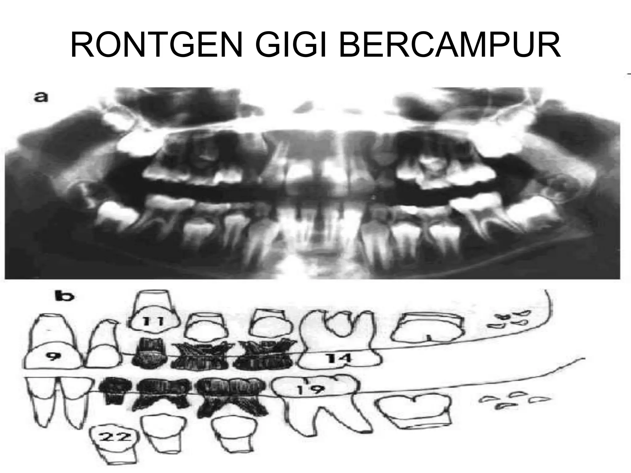 RONTGEN GIGI BERCAMPUR
 