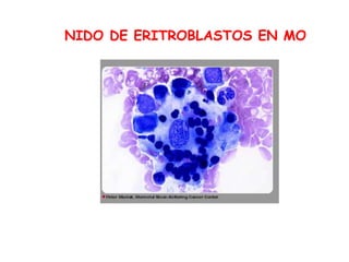 NIDO DE ERITROBLASTOS EN MO
 