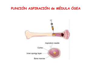 PUNCIÓN ASPIRACIÓN de MÉDULA ÓSEA
 