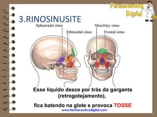 3.RINOSINUSITE




   Esse líquido desce por trás da garganta
             (retrogotejamento),
   fica batendo na glote e provoca TOSSE
              www.farmaceuticodigital.com
 
