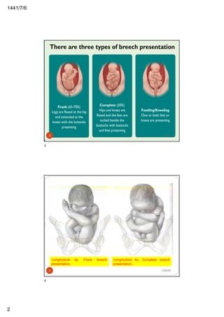 6/7/1441
2
2/29/203
3
Longitudinal lie. Frank breech
presentation.
I
I
Longitudinal lie. Complete breech
presentation.
2/29/204
4
 