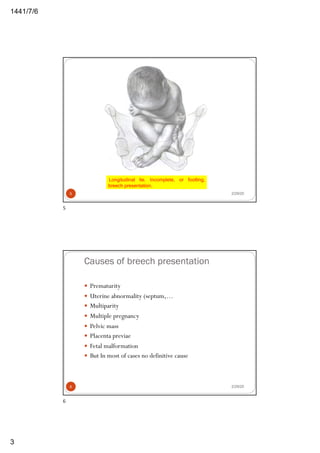 6/7/1441
3
Longitudinal lie. Incomplete, or footling,
breech presentation.
2/29/205
5
Causes of breech presentation
— Prematurity
— Uterine abnormality (septum,…
— Multiparity
— Multiple pregnancy
— Pelvic mass
— Placenta previae
— Fetal malformation
— But In most of cases no definitive cause
2/29/206
6
 