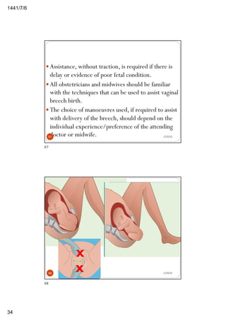 6/7/1441
34
2/29/20
— Assistance, without traction, is required if there is
delay or evidence of poor fetal condition.
— All obstetricians and midwives should be familiar
with the techniques that can be used to assist vaginal
breech birth.
— The choice of manoeuvres used, if required to assist
with delivery of the breech, should depend on the
individual experience/preference of the attending
doctor or midwife.67
67
2/29/2068
68
 