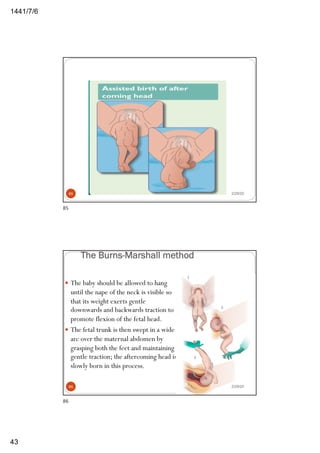 6/7/1441
43
2/29/2085
85
The Burns-Marshall method
— The baby should be allowed to hang
until the nape of the neck is visible so
that its weight exerts gentle
downwards and backwards traction to
promote flexion of the fetal head.
— The fetal trunk is then swept in a wide
arc over the maternal abdomen by
grasping both the feet and maintaining
gentle traction; the aftercoming head is
slowly born in this process.
2/29/2086
86
 