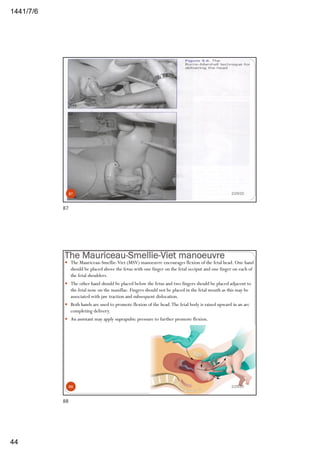 6/7/1441
44
2/29/2087
87
The Mauriceau-Smellie-Viet manoeuvre
— The Mauriceau-Smellie-Viet (MSV) manoeuvre encourages flexion of the fetal head. One hand
should be placed above the fetus with one finger on the fetal occiput and one finger on each of
the fetal shoulders.
— The other hand should be placed below the fetus and two fingers should be placed adjacent to
the fetal nose on the maxillae. Fingers should not be placed in the fetal mouth as this may be
associated with jaw traction and subsequent dislocation.
— Both hands are used to promote flexion of the head.The fetal body is raised upward in an arc
completing delivery.
— An assistant may apply suprapubic pressure to further promote flexion.
2/29/2088
88
 