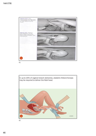6/7/1441
46
2/29/2091
91
In up to 20% of vaginal breech deliveries, obstetric Killand forceps
may be required to deliver the fetal head
2/29/2092
92
 