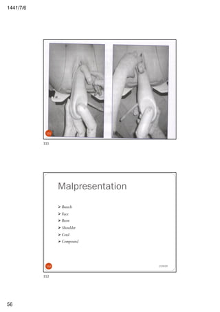6/7/1441
56
2/29/20111
111
Malpresentation
Ø Breech
Ø Face
Ø Brow
Ø Shoulder
Ø Cord
Ø Compound
2/29/20112
112
 
