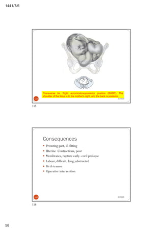 6/7/1441
58
Transverse lie. Right acromiodorsoposterior position (RADP). The
shoulder of the fetus is to the mother's right, and the back is posterior.
2/29/20115
115
Consequences
— Presnting part, ill-fitting
— Uterine Contractions, poor
— Membranes, rupture early- cord prolapse
— Labour, difficult, long, obstructed
— Birth trauma
— Operative intervention
2/29/20116
116
 