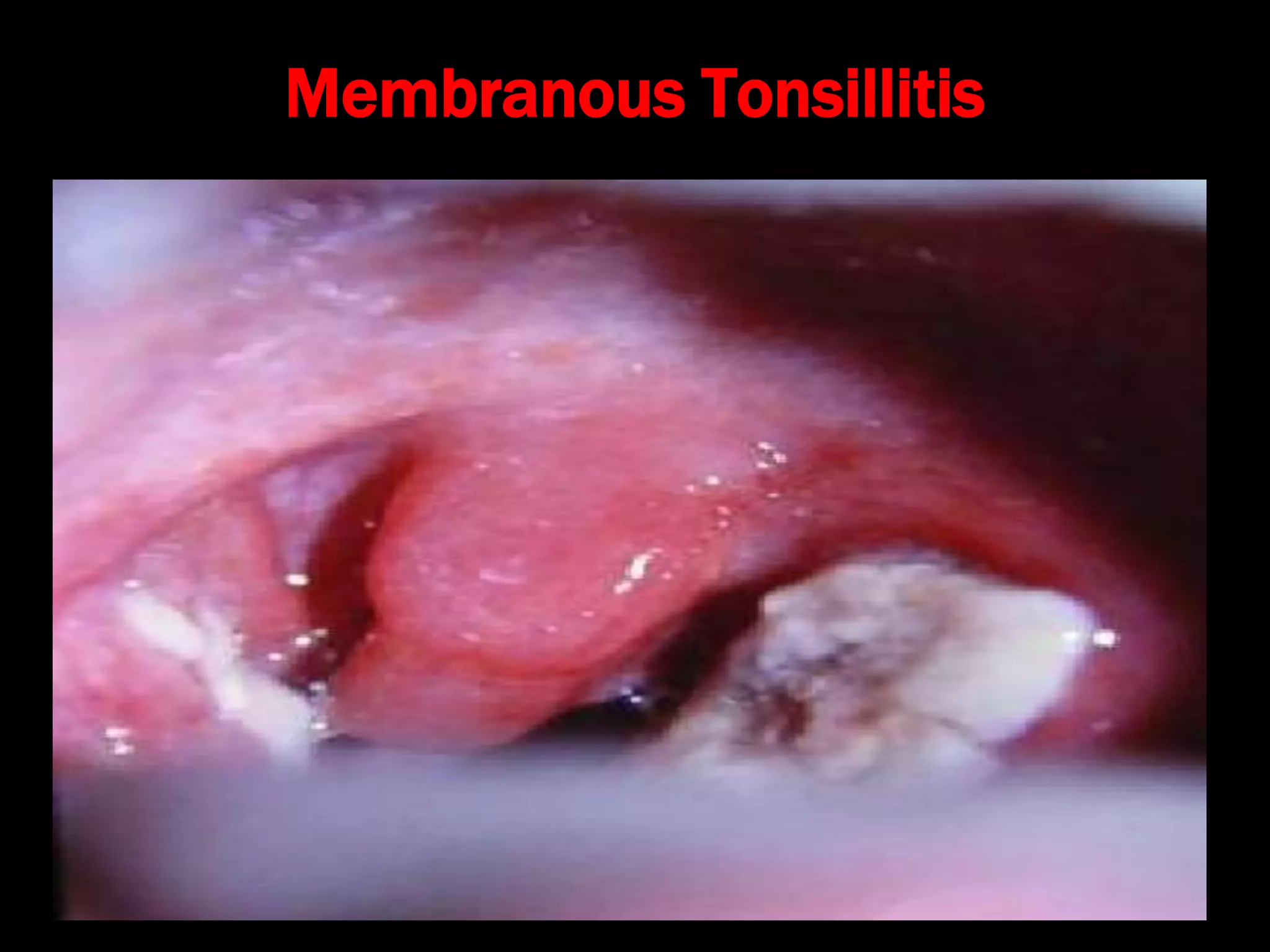 Membranous Tonsillitis
 