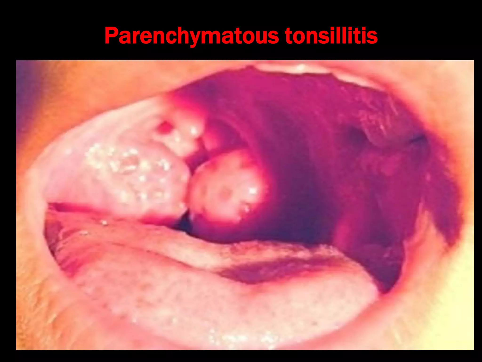 Parenchymatous tonsillitis
 