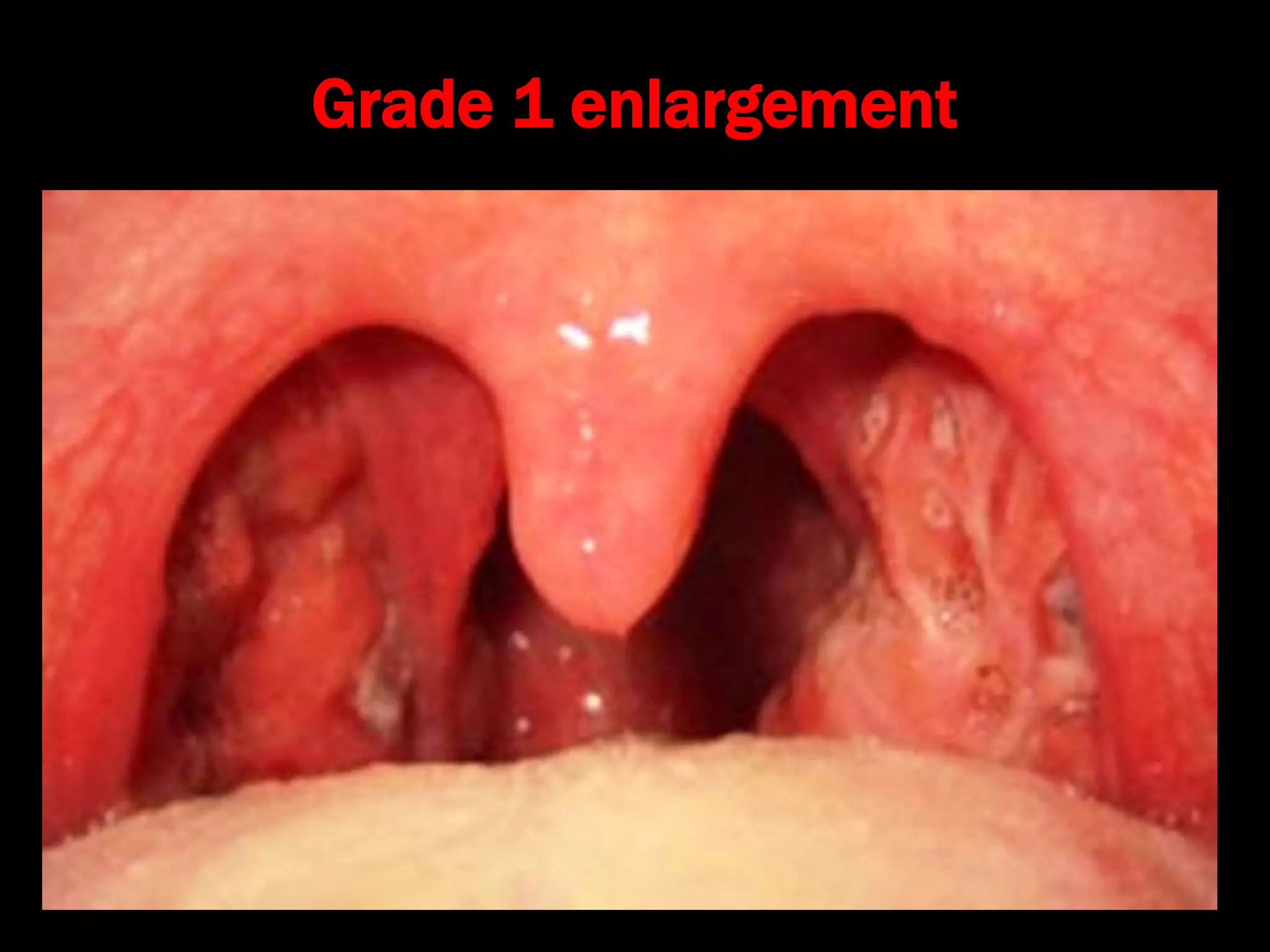 Grade 1 enlargement
 