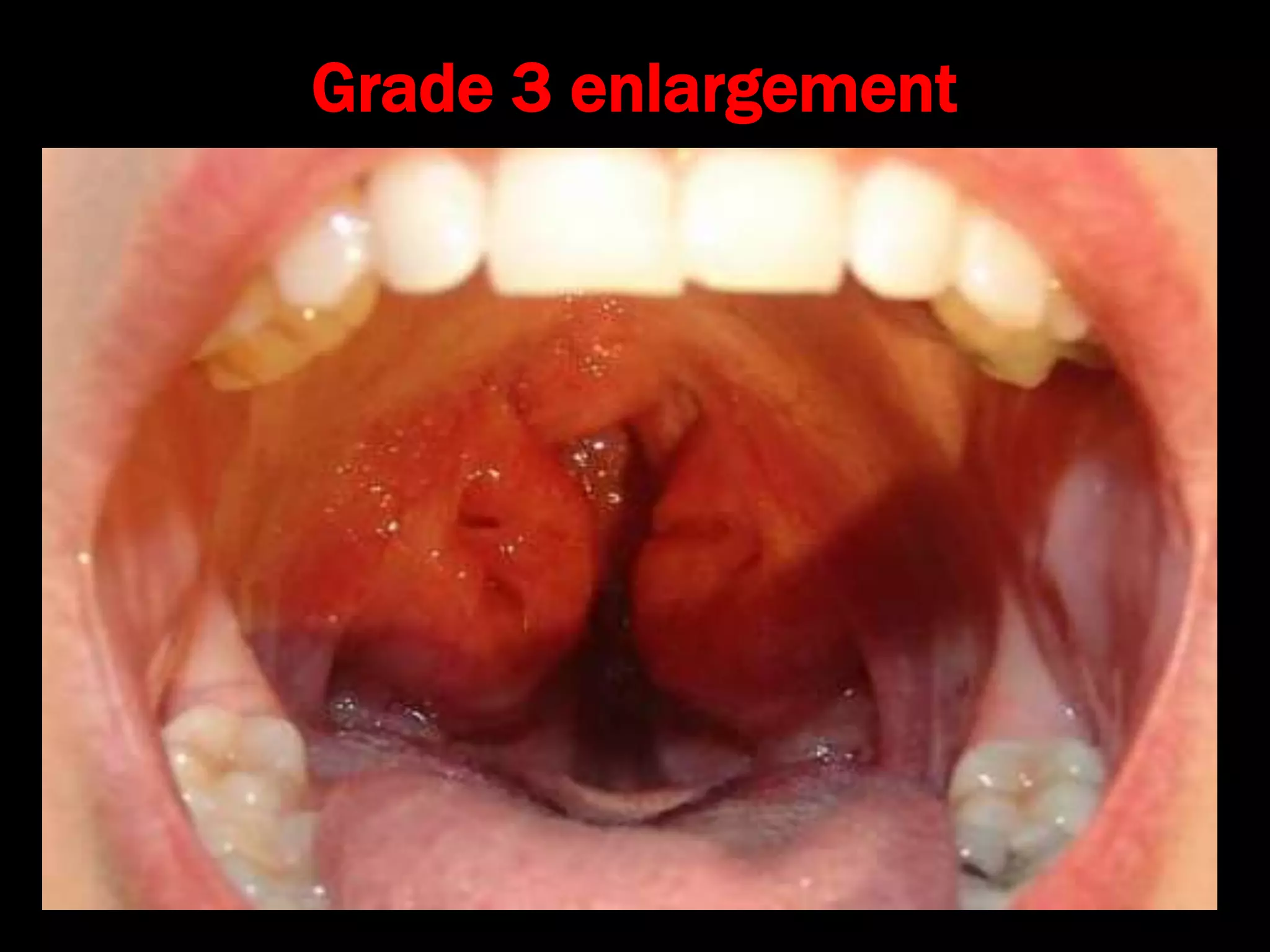 Grade 3 enlargement
 