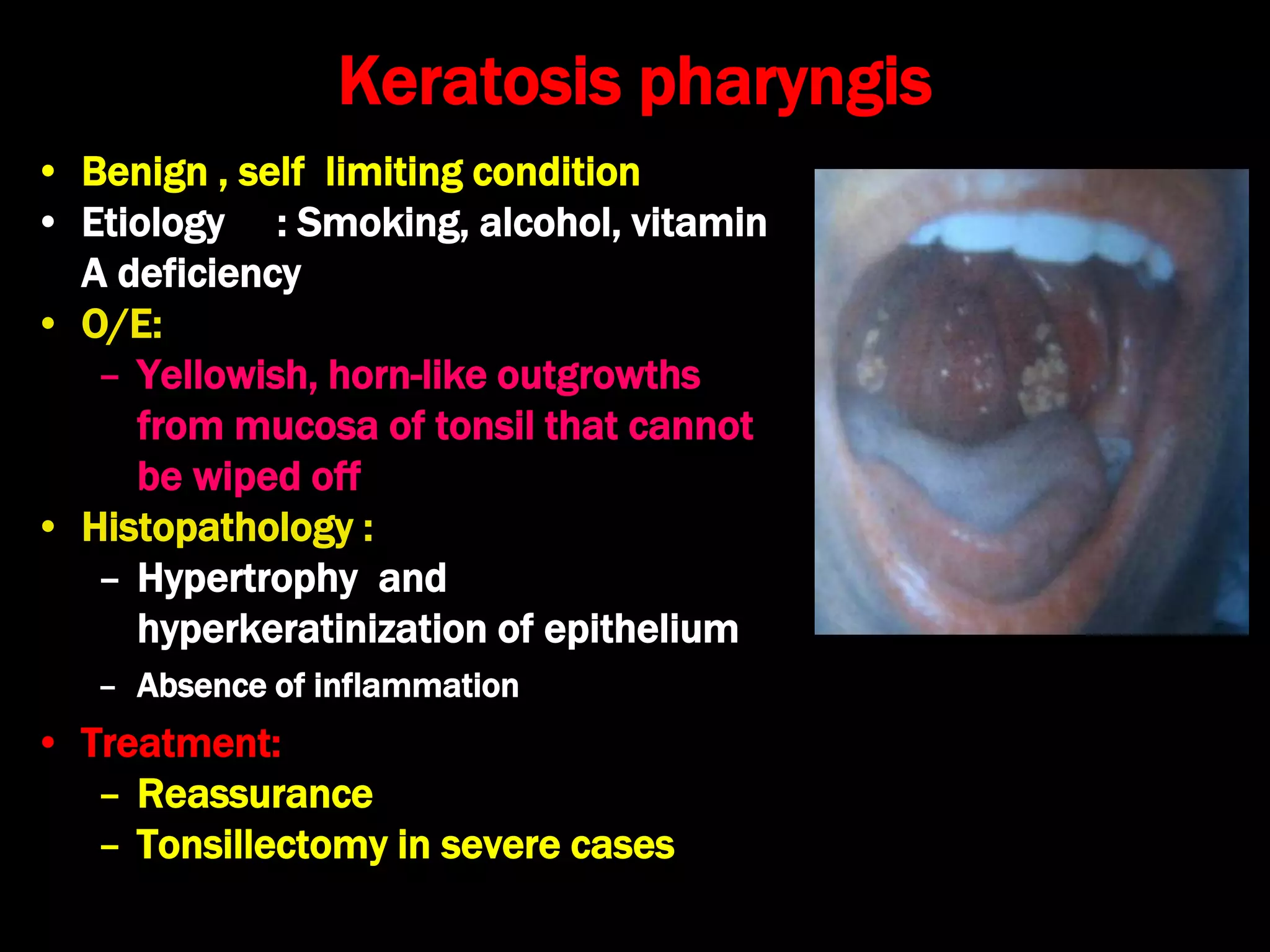 Keratosis pharyngis
• Benign , self limiting condition
• Etiology : Smoking, alcohol, vitamin
A deficiency
• O/E:
– Yellowish, horn-like outgrowths
from mucosa of tonsil that cannot
be wiped off
• Histopathology :
– Hypertrophy and
hyperkeratinization of epithelium
– Absence of inflammation
• Treatment:
– Reassurance
– Tonsillectomy in severe cases
 