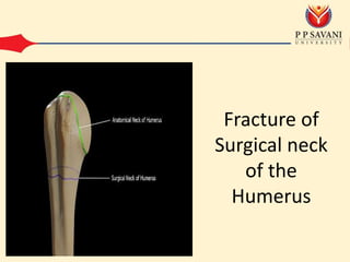 Fracture of
Surgical neck
of the
Humerus
 