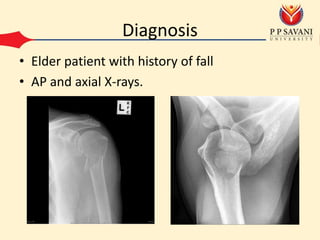 Fall Axially 3. Fracture of Greater Tuberosity and Surgical Neck of Humerus | PPTX