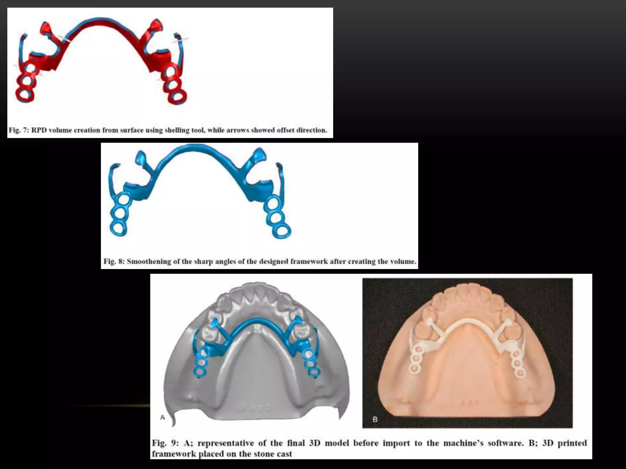 Split Major Connector Rpd MAJOR CONNECTORS AND MINOR CONNECTORS IN RPD - Dr Prathibha Prasad | PPTX